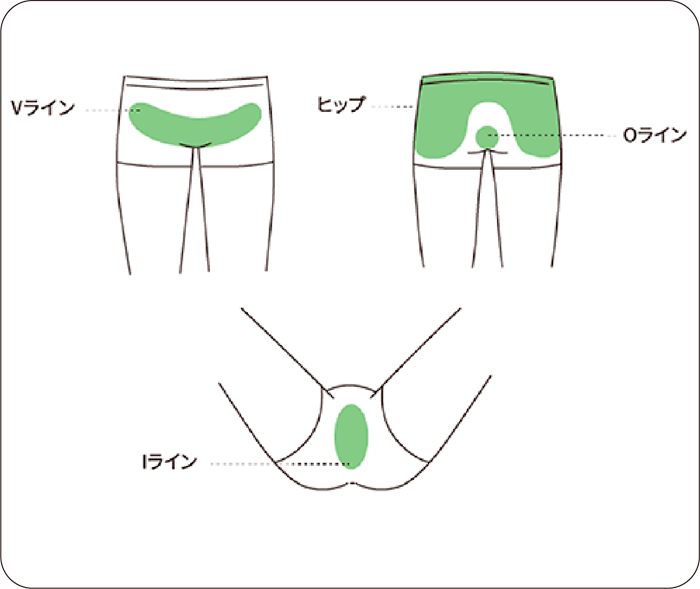 陰部脱毛施術箇所